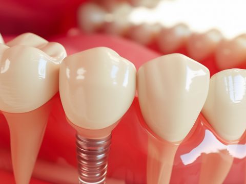 Implantat oder Brücke: Wann passt welche Lösung am besten zu Ihnen?